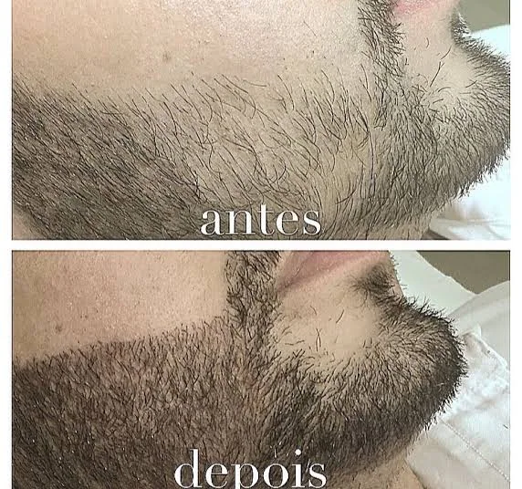 Antes e depois de camuflagem de barba, exemplo 2