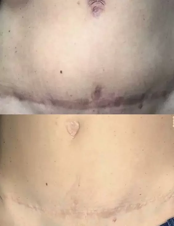 Antes e depois de camuflagem de cicatriz, exemplo 1