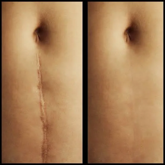 Antes e depois de camuflagem de cicatriz, exemplo 3