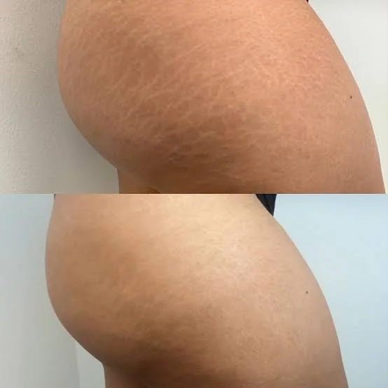 Antes e depois de camuflagem de estrias, exemplo 3