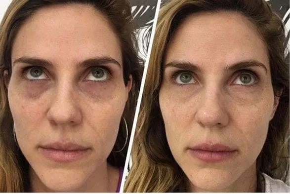 Antes e depois de camuflagem de olheiras, exemplo 2