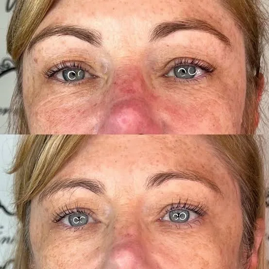 Antes e depois de jato de plasma, exemplo 1