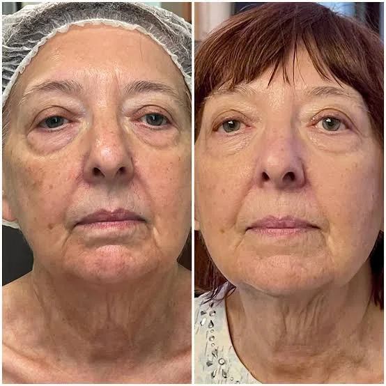 Antes e depois de jato de plasma, exemplo 3